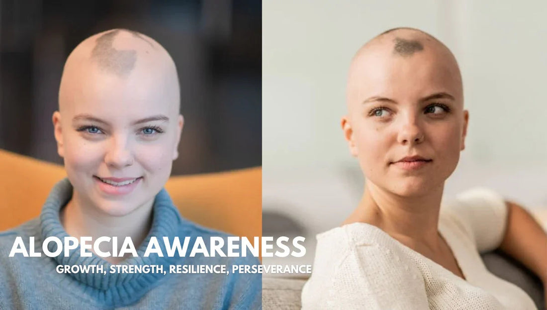 Coping with Alopecia Embracing Confidence and Comfort